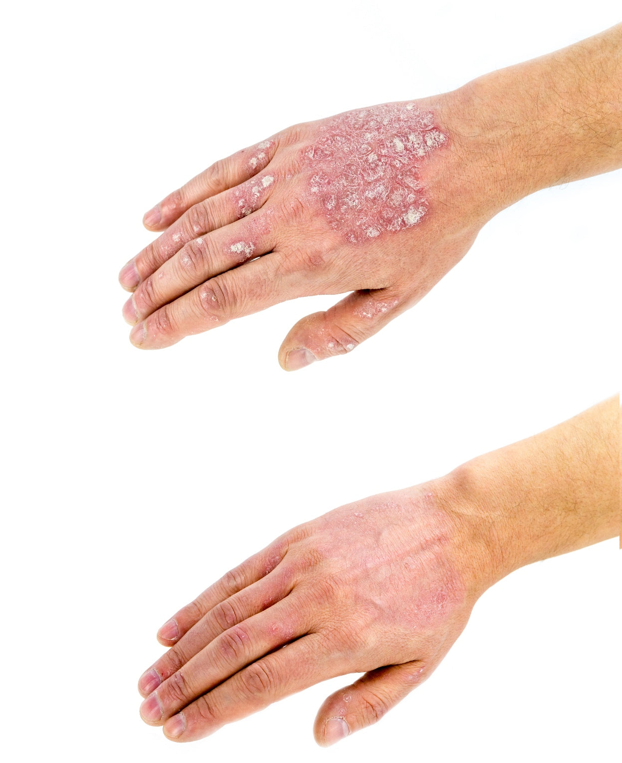 Before and after phototherapy treatment on psoriasis